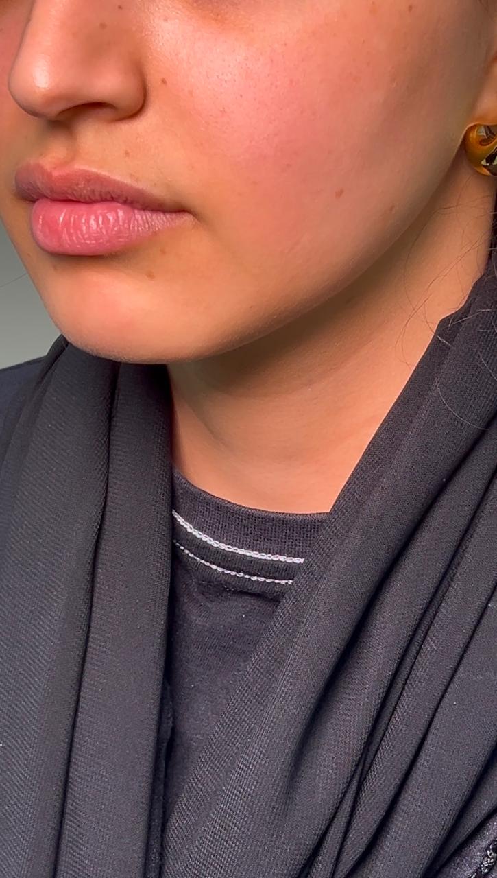 فيلر فل فيس — د. بسمة عبدالكافي قبل